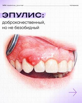 Фиброзный, ангиоматозный, гигантоклеточный: три типа эпулиса, одна угроза.